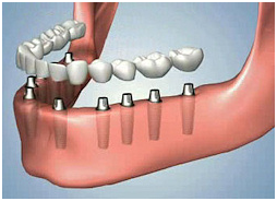 dental_impacts_11