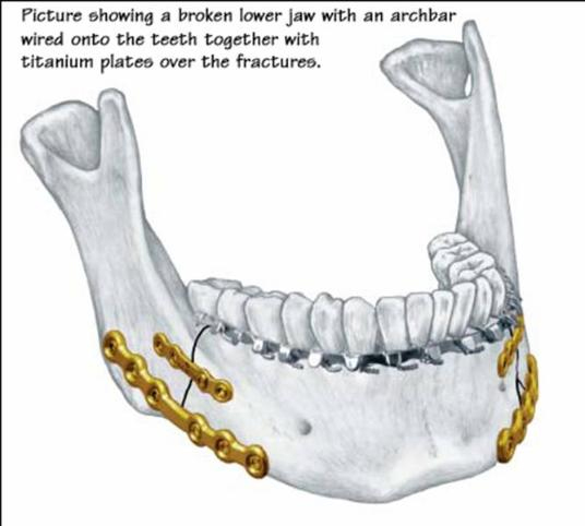 jaw fracture-1