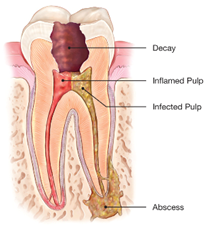 Root-Canal-Treatment1