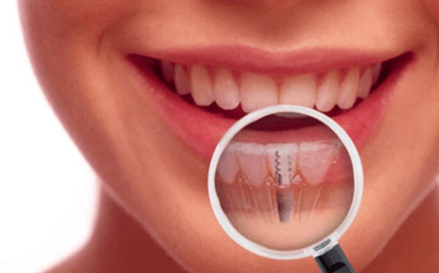 YOUR THIRD DENTITION- DENTAL IMPLANTS