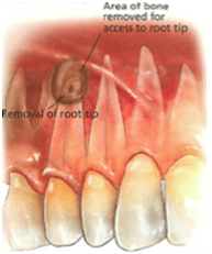 Dentoalveolar-Surgery1