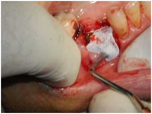 Dentoalveolar-Surgery2