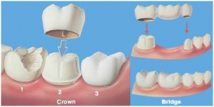 Fixed-teeth-bridge1