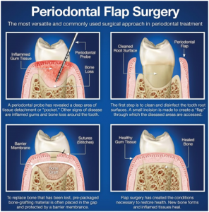 Flap-Surgery1