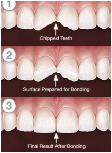 Fracture-Tooth1