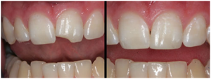 Fracture-Tooth2