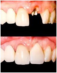 Fracture-Tooth3