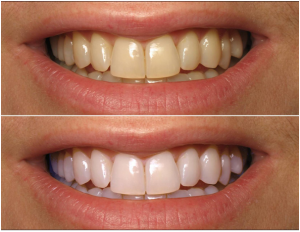 Teeth-Whitening1