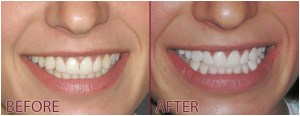 Teeth-Whitening2